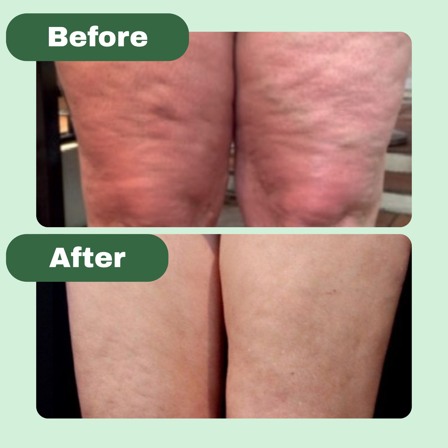 Ryvoro™ Cellulite Massage Oil
